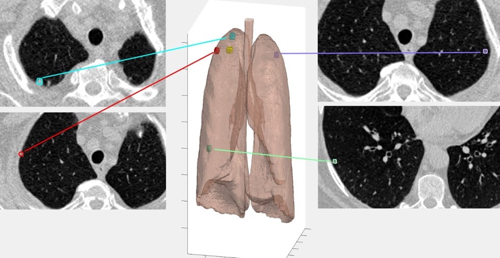 nodule detection cancer quantacell JRF SFR