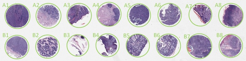 TMA analysis, tissue micro array