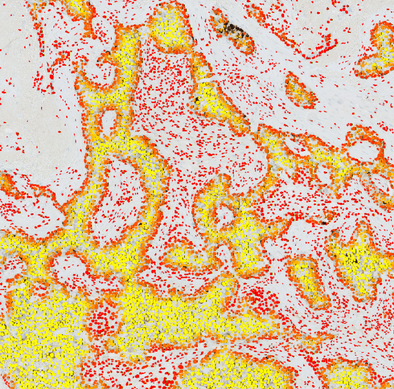 Screenshot — Distance map on a Ki67-stained breast cancer WSI (ACROBAT dataset). Red: healthy tissue / invasive front. Yellow: tumor core. All detected cells shown.