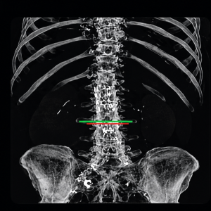 Sarcomenia detection, L3 detection with deep learning for clinical use