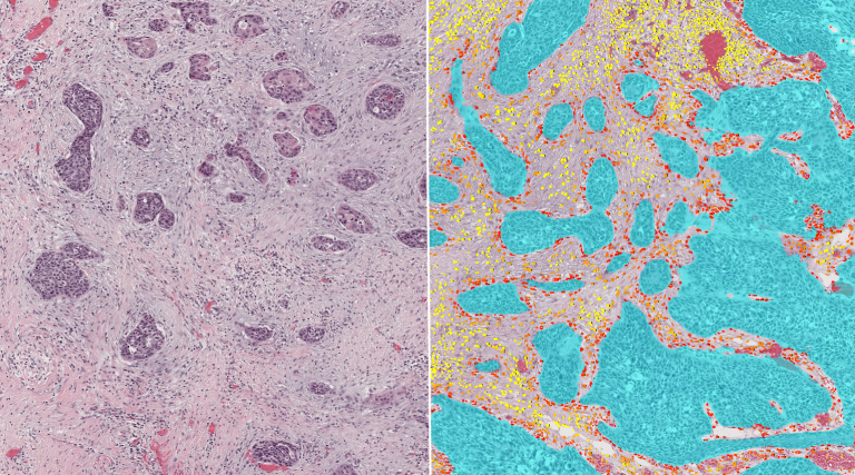 Distance of cells associated with the tumor microenvironment, represented by a red-to-yellow gradient from closest to farthest cells