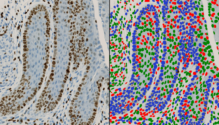 Nuclei detection and classification (red and green), DAB segmentation (blue)