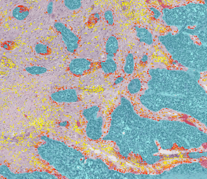 CHU... Spatial analysis of cell populations in the tumor microenvironment