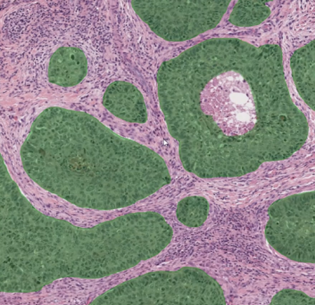 DL model tumor detection AI detection and segmentation of tumor regions in histopathology images