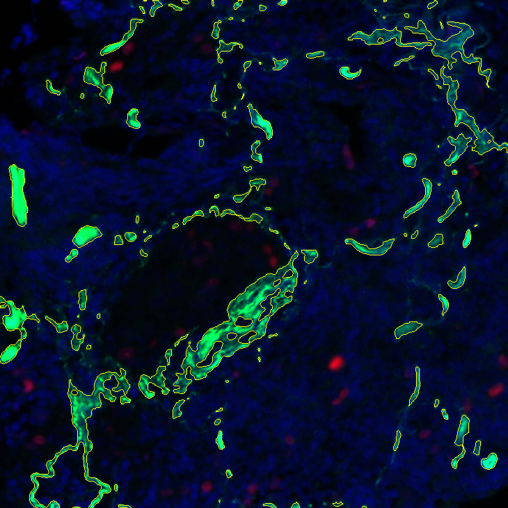 Fibrosis Detection – Lung Fluorescence Fibrosis detection in fluorescence microscopy images of lung tissue
