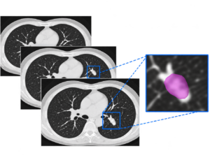 AI-based lung nodule detection in 3D CT imaging – IBM × QuantaCell collaboration
