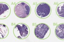 TMA analysis, tissue micro array